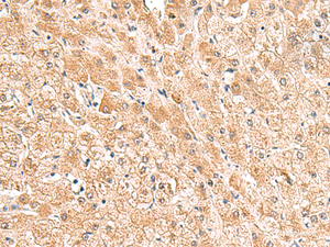 Immunohistochemistry of paraffin-embedded Human liver cancer tissue using TRUB1 Polyclonal Antibody at dilution of 1:85 (×200)