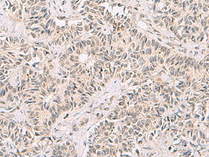 Immunohistochemistry of paraffin-embedded Human ovarian cancer tissue using RNF13 Polyclonal Antibody at dilution of 1:60 (×200)