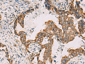 Immunohistochemistry of paraffin-embedded Human cervical cancer tissue using PDHA1 Polyclonal Antibody at dilution of 1:50 (×200)