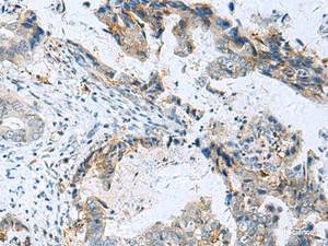 Immunohistochemistry of paraffin-embedded Human cervical cancer tissue using RMDN2 Polyclonal Antibody at dilution of 1:70 (×200)
