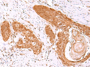 Immunohistochemistry of paraffin-embedded Human esophagus cancer tissue using FDPS Polyclonal Antibody at dilution of 1:60 (×200)