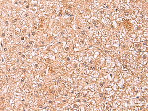 Immunohistochemistry of paraffin-embedded Human liver cancer tissue using ASTN2 Polyclonal Antibody at dilution of 1:80 (×200)