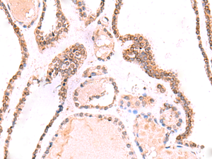 Immunohistochemistry of paraffin-embedded Human thyroid cancer tissue using TOR1AIP1 Polyclonal Antibody at dilution of 1:70 (×200)