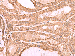 Immunohistochemistry of paraffin-embedded Human thyroid cancer tissue using CDC20 Polyclonal Antibody at dilution of 1:70 (×200)