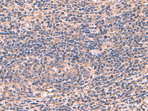 Immunohistochemistry of paraffin-embedded Human cervical cancer tissue using AHCYL1 Polyclonal Antibody at dilution of 1:70 (×200)