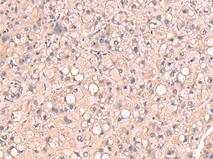 Immunohistochemistry of paraffin-embedded Human liver cancer tissue using RIOK1 Polyclonal Antibody at dilution of 1:80 (×200)