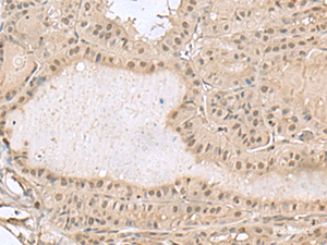 Immunohistochemistry of paraffin-embedded Human thyroid cancer tissue using PCLAF Polyclonal Antibody at dilution of 1:50 (×200)