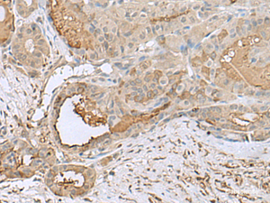 Immunohistochemistry of paraffin-embedded Human thyroid cancer tissue using GABARAPL2 Polyclonal Antibody at dilution of 1:55 (×200)