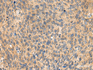 Immunohistochemistry of paraffin-embedded Human cervical cancer tissue using MIA Polyclonal Antibody at dilution of 1:100 (×200)