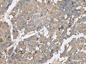 Immunohistochemistry of paraffin-embedded Human liver cancer tissue using PLA2G2A Polyclonal Antibody at dilution of 1:50 (×200)