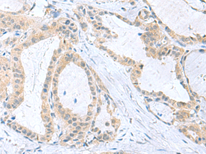 Immunohistochemistry of paraffin-embedded Human thyroid cancer tissue using PDE6D Polyclonal Antibody at dilution of 1:50 (×200)