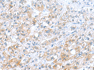 Immunohistochemistry of paraffin-embedded Human liver cancer tissue using DNAL1 Polyclonal Antibody at dilution of 1:70 (×200)