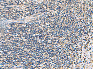 Immunohistochemistry of paraffin-embedded Human cervical cancer tissue using ATP5F1D Polyclonal Antibody at dilution of 1:55 (×200)