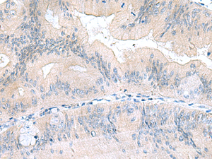Immunohistochemistry of paraffin-embedded Human colorectal cancer tissue using UBE2F Polyclonal Antibody at dilution of 1:70 (×200)
