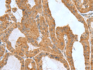 Immunohistochemistry of paraffin-embedded Human thyroid cancer tissue using ITGB1BP1 Polyclonal Antibody at dilution of 1:50 (×200)