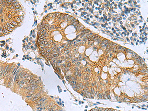 Immunohistochemistry of paraffin-embedded Human colorectal cancer tissue using GUCA1A Polyclonal Antibody at dilution of 1:105 (×200)