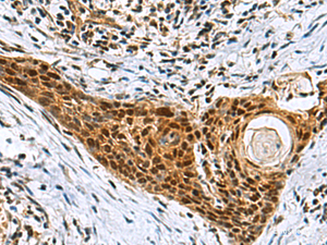 Immunohistochemistry of paraffin-embedded Human esophagus cancer tissue using NABP1 Polyclonal Antibody at dilution of 1:80 (×200)