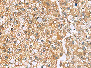 Immunohistochemistry of paraffin-embedded Human liver cancer tissue using MRPL22 Polyclonal Antibody at dilution of 1:50 (×200)