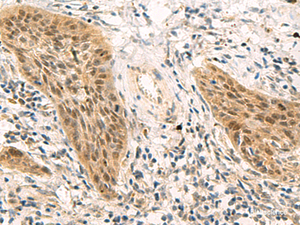 Immunohistochemistry of paraffin-embedded Human esophagus cancer tissue using PSME1 Polyclonal Antibody at dilution of 1:50 (×200)