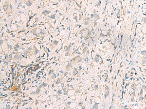 Immunohistochemistry of paraffin-embedded Human liver cancer tissue using SUSD3 Polyclonal Antibody at dilution of 1:95 (×200)