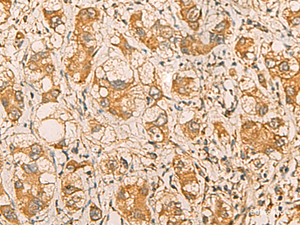 Immunohistochemistry of paraffin-embedded Human liver cancer tissue using MRPL9 Polyclonal Antibody at dilution of 1:55 (×200)