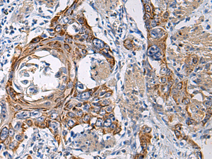 Immunohistochemistry of paraffin-embedded Human esophagus cancer tissue using RITA1 Polyclonal Antibody at dilution of 1:60 (×200)