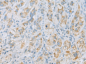 Immunohistochemistry of paraffin-embedded Human liver cancer tissue using PLA2G15 Polyclonal Antibody at dilution of 1:65 (×200)