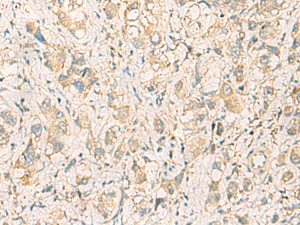 Immunohistochemistry of paraffin-embedded Human liver cancer tissue using F11R Polyclonal Antibody at dilution of 1:40 (×200)