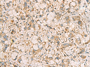 Immunohistochemistry of paraffin-embedded Human liver cancer tissue using PRKRA Polyclonal Antibody at dilution of 1:65 (×200)