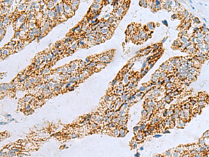 Immunohistochemistry of paraffin-embedded Human gastric cancer tissue using PYCR2 Polyclonal Antibody at dilution of 1:40 (×200)
