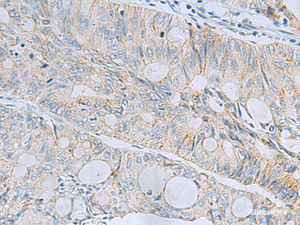 Immunohistochemistry of paraffin-embedded Human colorectal cancer tissue using MSI2 Polyclonal Antibody at dilution of 1:60 (×200)