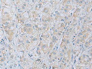 Immunohistochemistry of paraffin-embedded Human liver cancer tissue using NAGK Polyclonal Antibody at dilution of 1:35 (×200)