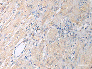 Immunohistochemistry of paraffin-embedded Human gastric cancer tissue using GNAI1 Polyclonal Antibody at dilution of 1:130 (×200)