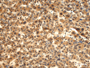 Immunohistochemistry of paraffin-embedded Human liver cancer tissue using TMOD1 Polyclonal Antibody at dilution of 1:60 (×200)