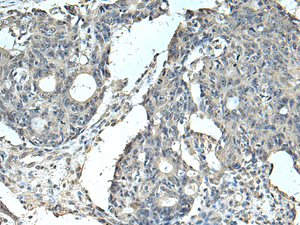Immunohistochemistry of paraffin-embedded Human colorectal cancer tissue using SLC35F6 Polyclonal Antibody at dilution of 1:95 (×200)