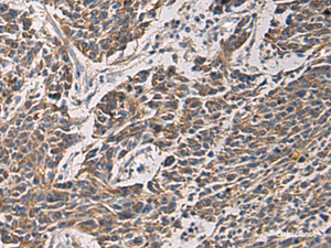 Immunohistochemistry of paraffin-embedded Human colorectal cancer tissue using MAPKAPK3 Polyclonal Antibody at dilution of 1:95 (×200)