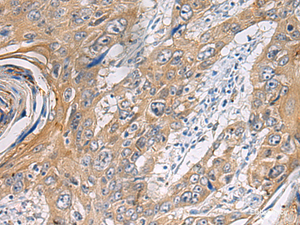 Immunohistochemistry of paraffin-embedded Human esophagus cancer tissue using PA2G4 Polyclonal Antibody at dilution of 1:60 (×200)