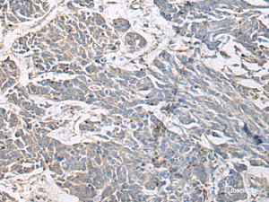 Immunohistochemistry of paraffin-embedded Human colorectal cancer tissue using PRKCSH Polyclonal Antibody at dilution of 1:65 (×200)