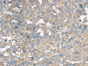 Immunohistochemistry of paraffin-embedded Human liver cancer tissue using CXCR5 Polyclonal Antibody at dilution of 1:80 (×200)