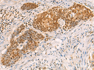 Immunohistochemistry of paraffin-embedded Human esophagus cancer tissue using SREBF2 Polyclonal Antibody at dilution of 1:50 (×200)