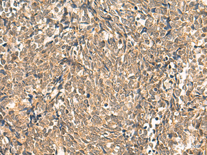 Immunohistochemistry of paraffin-embedded Human lung cancer tissue using HNF1A Polyclonal Antibody at dilution of 1:50 (×200)