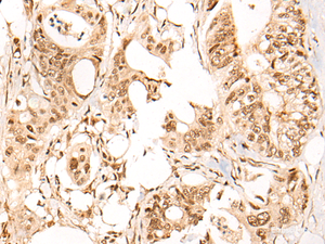 Immunohistochemistry of paraffin-embedded Human colorectal cancer tissue using ARID1B Polyclonal Antibody at dilution of 1:40 (×200)