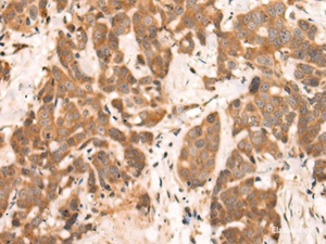 Immunohistochemistry of paraffin-embedded Human thyroid cancer tissue using NRG2 Polyclonal Antibody at dilution of 1:65 (×200)