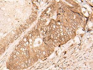 Immunohistochemistry of paraffin-embedded Human colorectal cancer tissue using HIPK3 Polyclonal Antibody at dilution of 1:60 (×200)