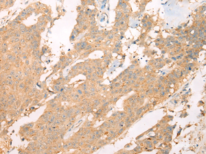 Immunohistochemistry of paraffin-embedded Human colorectal cancer tissue using ASIC3 Polyclonal Antibody at dilution of 1:40 (×200)