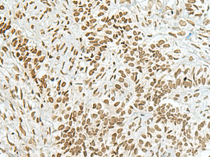 Immunohistochemistry of paraffin-embedded Human ovarian cancer tissue using HAS1 Polyclonal Antibody at dilution of 1:70 (×200)