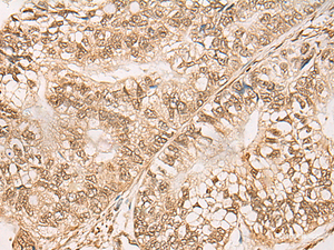 Immunohistochemistry of paraffin-embedded Human gastric cancer tissue using WEE1 Polyclonal Antibody at dilution of 1:35 (×200)