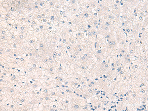 Immunohistochemistry of paraffin-embedded Human liver cancer tissue using CEBPB Polyclonal Antibody at dilution of 1:30 (×200)