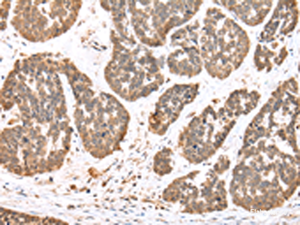 Immunohistochemistry of paraffin-embedded Human esophagus cancer tissue using DDX58 Polyclonal Antibody at dilution of 1:35 (×200)