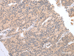 Immunohistochemistry of paraffin-embedded Human prost at e cancer tissue using DEFB112 Polyclonal Antibody at dilution of 1:40 (×200)